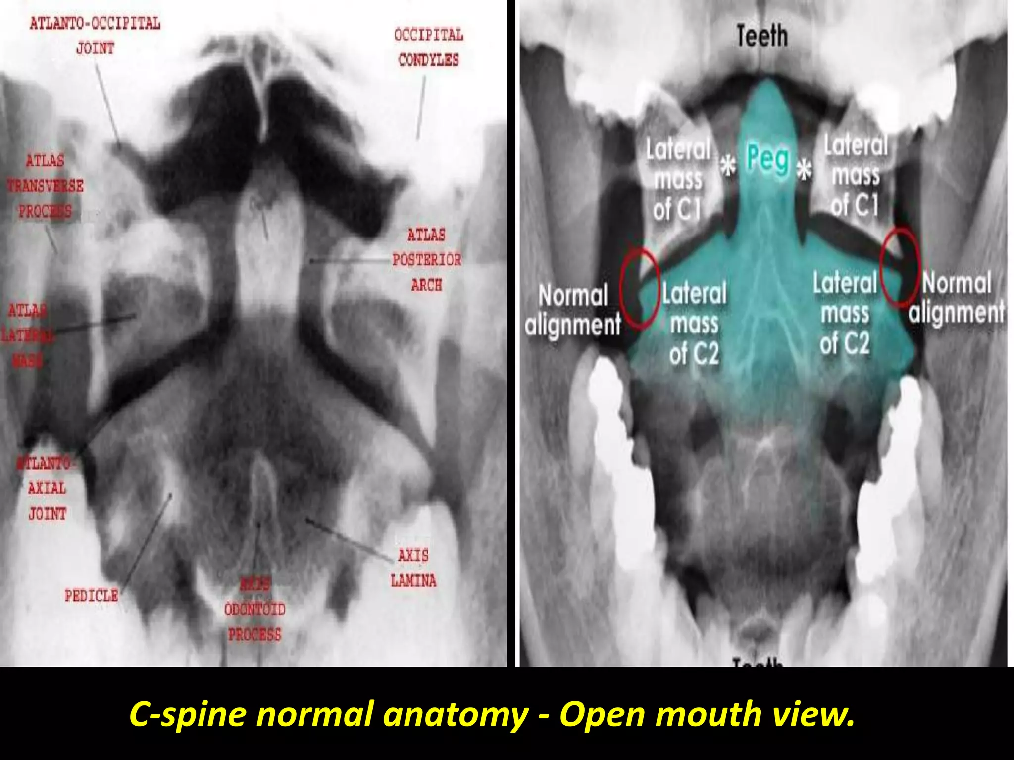 C-spine normal anatomy - Open mouth view. 
 