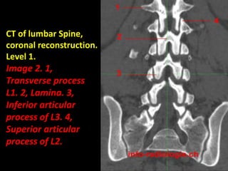 Presentation1.pptx, normal spinal anatomy.