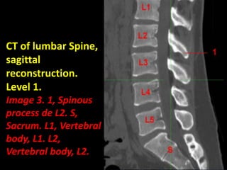 Presentation1.pptx, normal spinal anatomy.