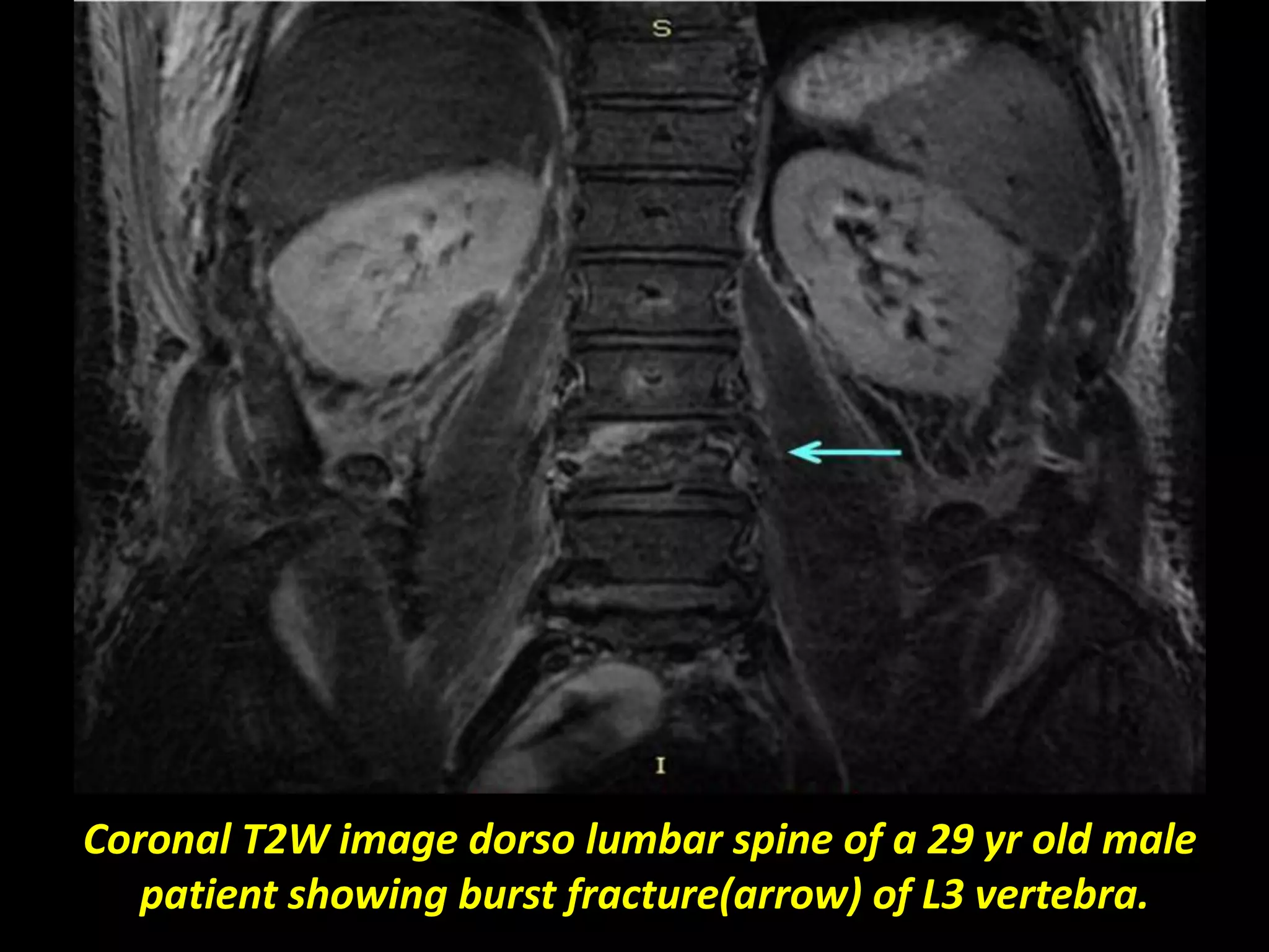 Coronal T2W image dorso lumbar spine of a 29 yr old male 
patient showing burst fracture(arrow) of L3 vertebra. 
 