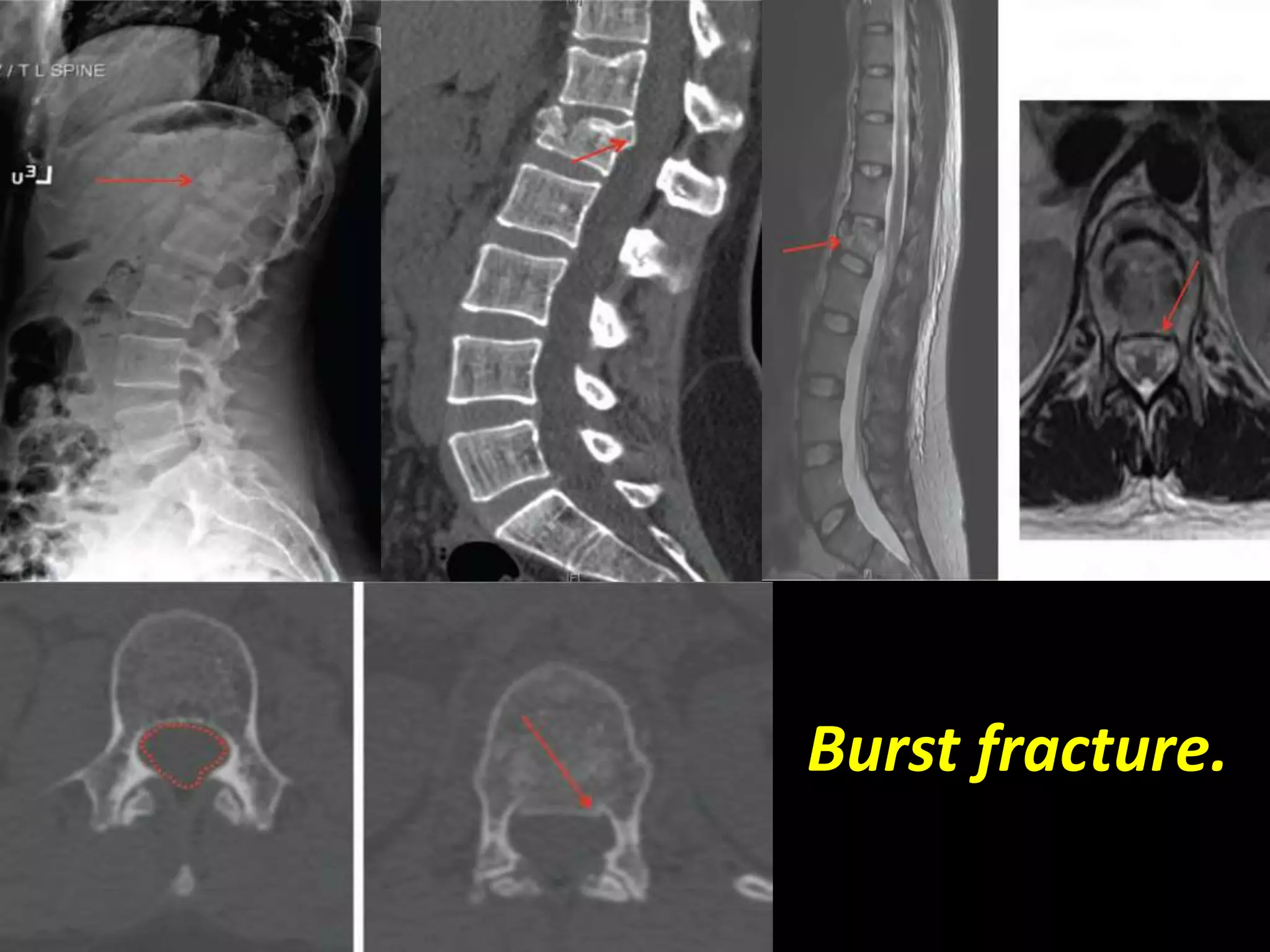 Burst fracture. 
 
