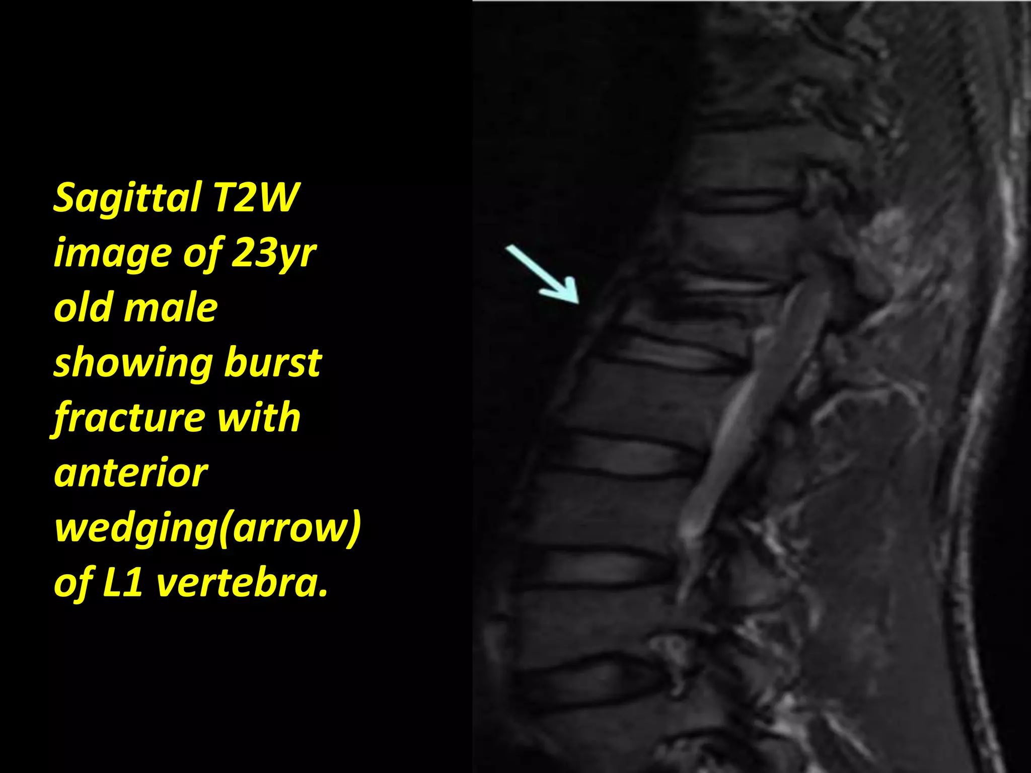 Sagittal T2W 
image of 23yr 
old male 
showing burst 
fracture with 
anterior 
wedging(arrow) 
of L1 vertebra. 
 