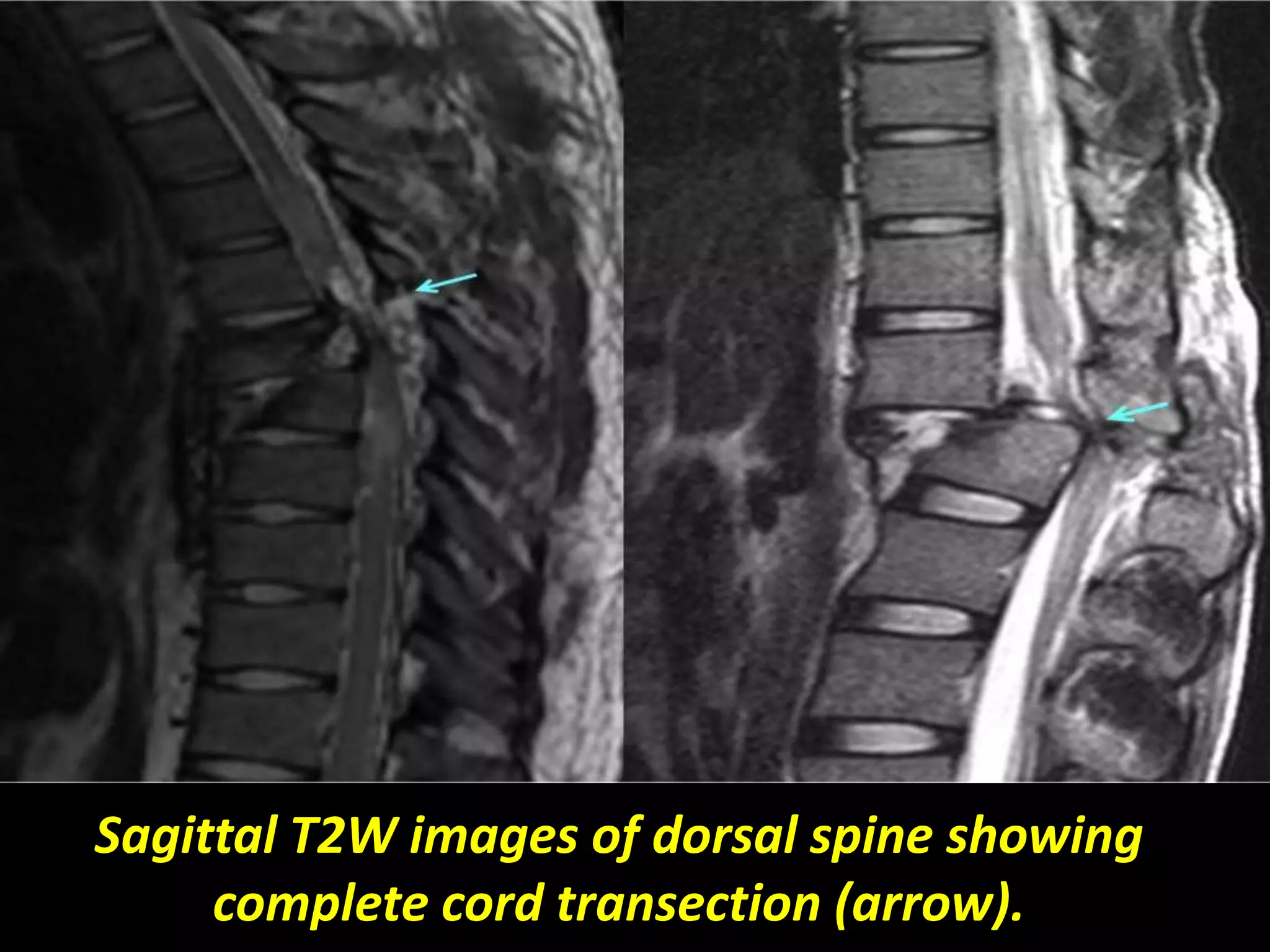 Sagittal T2W images of dorsal spine showing 
complete cord transection (arrow). 
 