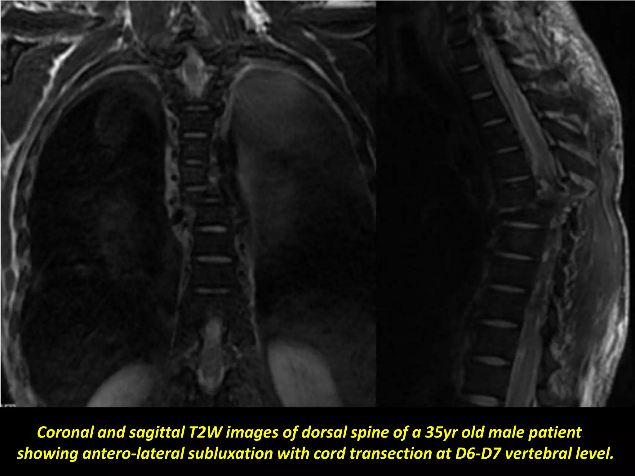 Coronal and sagittal T2W images of dorsal spine of a 35yr old male patient 
showing antero-lateral subluxation with cord transection at D6-D7 vertebral level. 
 