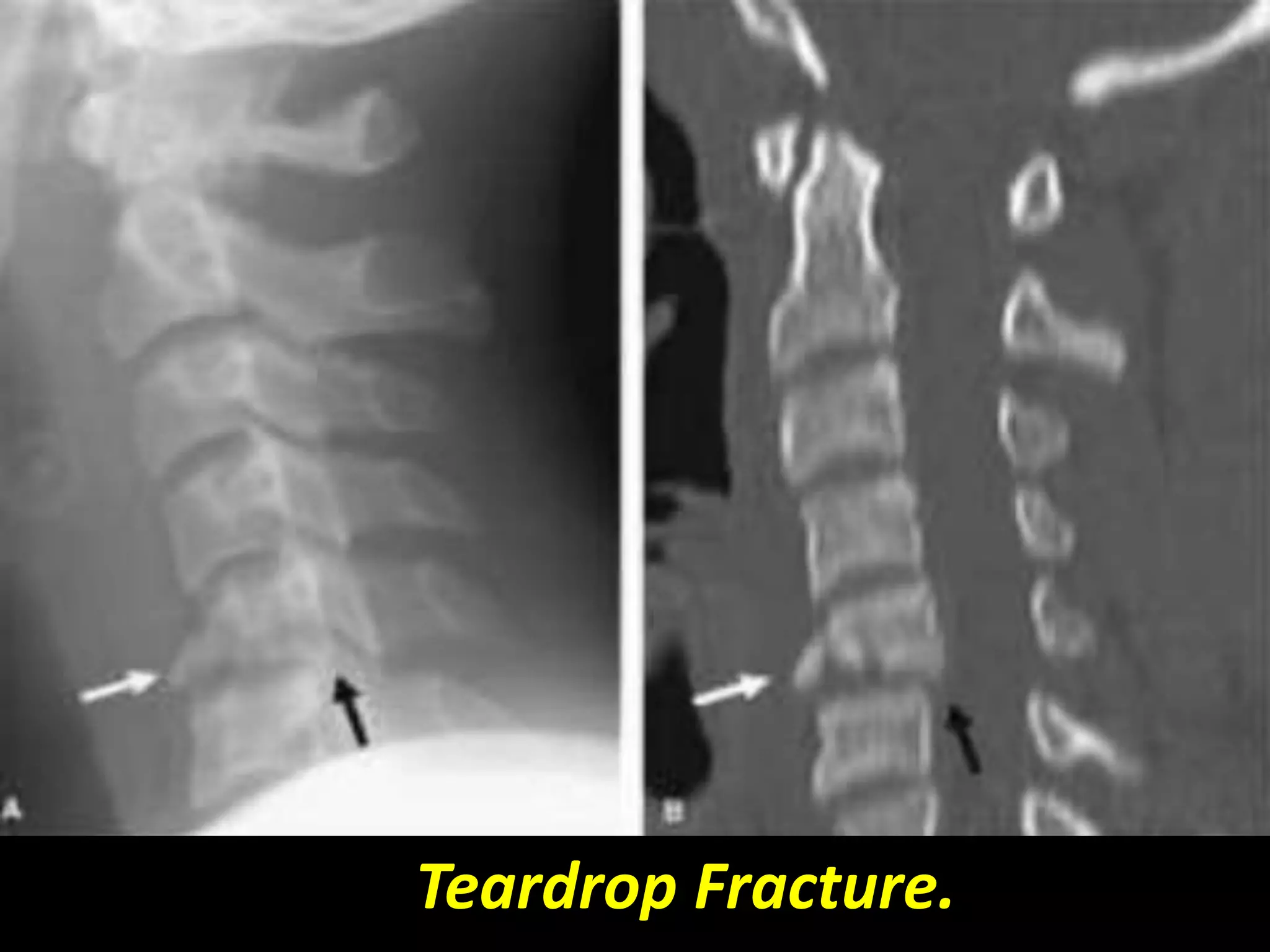 Teardrop Fracture. 
 