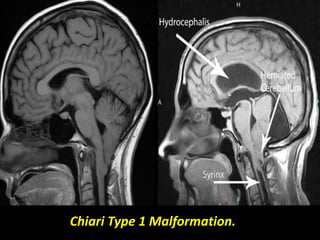 Chiari-11 malformation: 
Usually accompanied by a lumbar or lumbosacral 
myelomeningocele with tonsillar herniation below ...