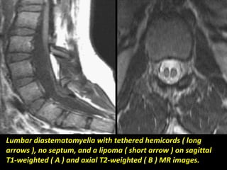 MRI Sagittal T2w images of lumbo sacral spine shows: Hypoplastic S1 and 
S2 with failure of formation of S3 and onwards. C...