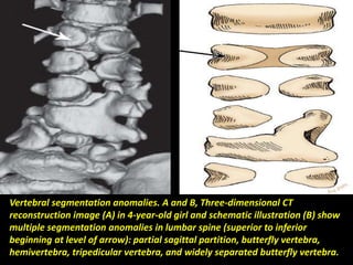 Presentation1.pptx, radiological imaging of congenital anomalies of the spine and spinal cord.