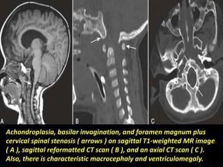 Basilar invagination and 
Chiari I malformation on 
sagittal T2-weighted MR 
image with short clivus and 
high dens ( ante...