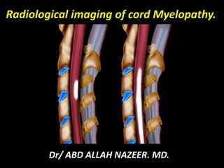 Radiological imaging of cord Myelopathy. 
Dr/ ABD ALLAH NAZEER. MD. 
 