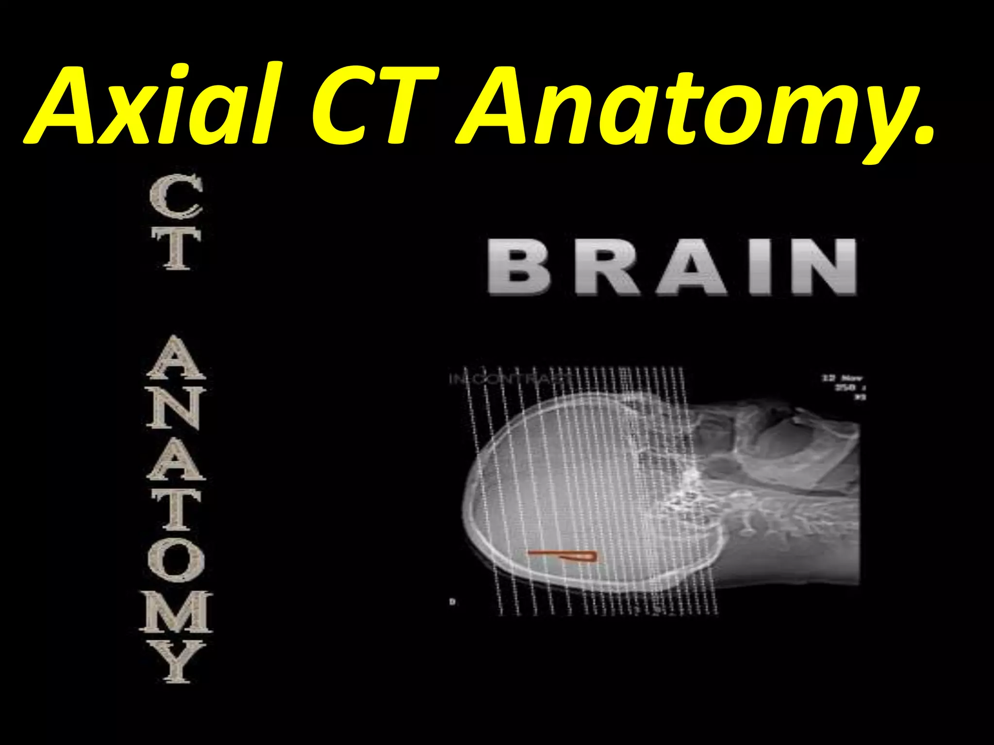 Axial CT Anatomy. 
 