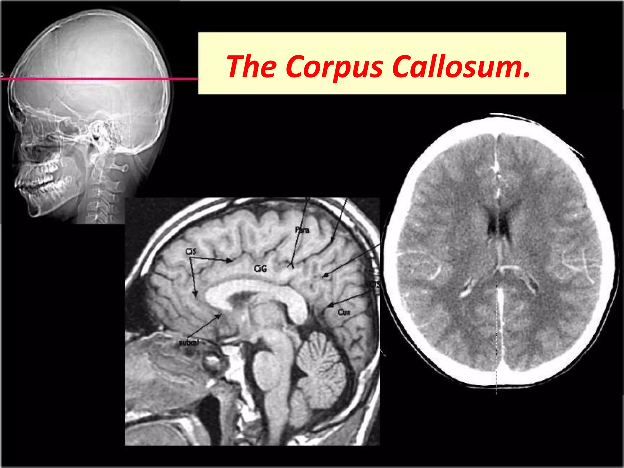 The Corpus Callosum. 
 