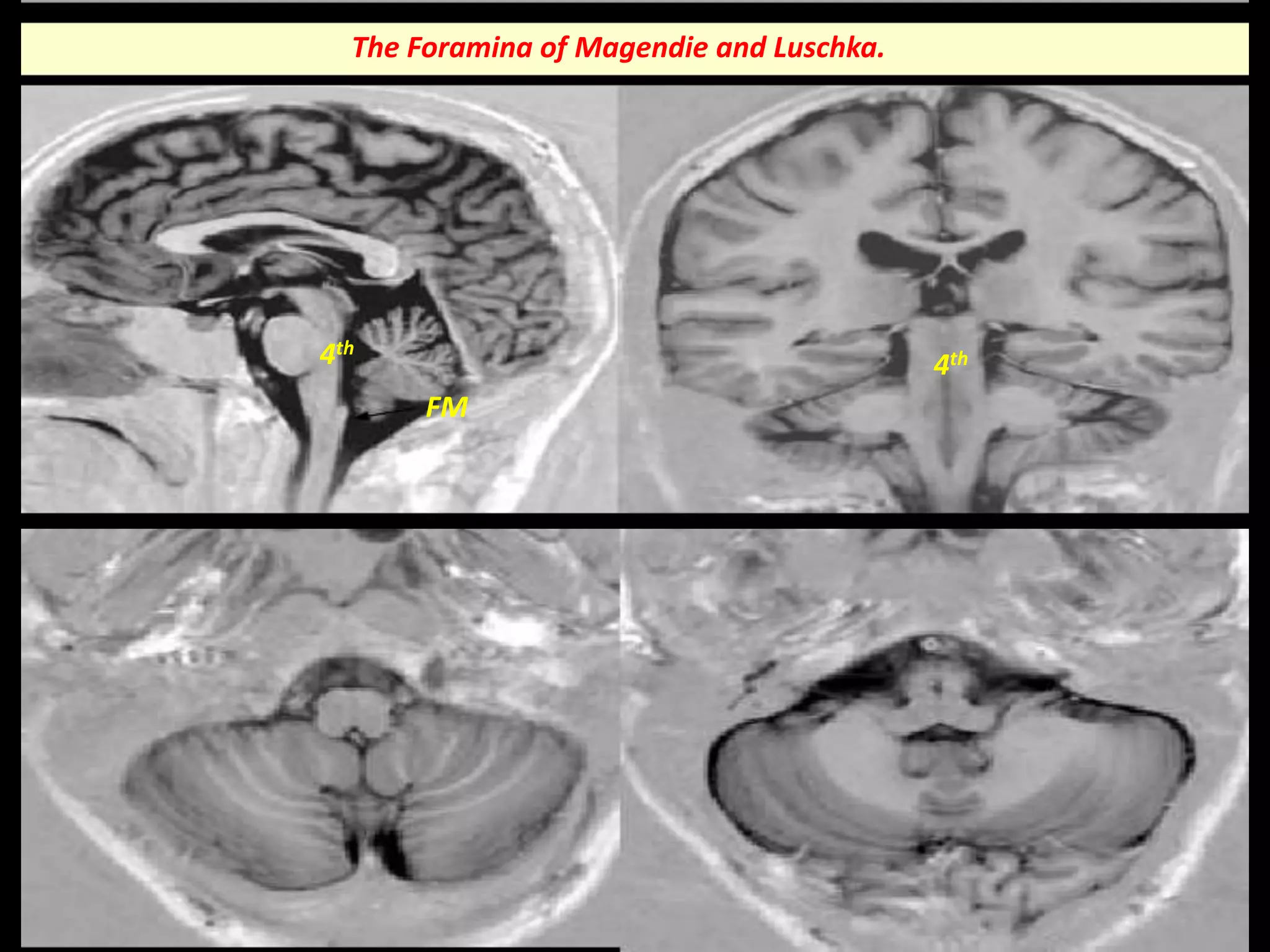 The Foramina of Magendie and Luschka. 
4th 
FM 
4th 
 