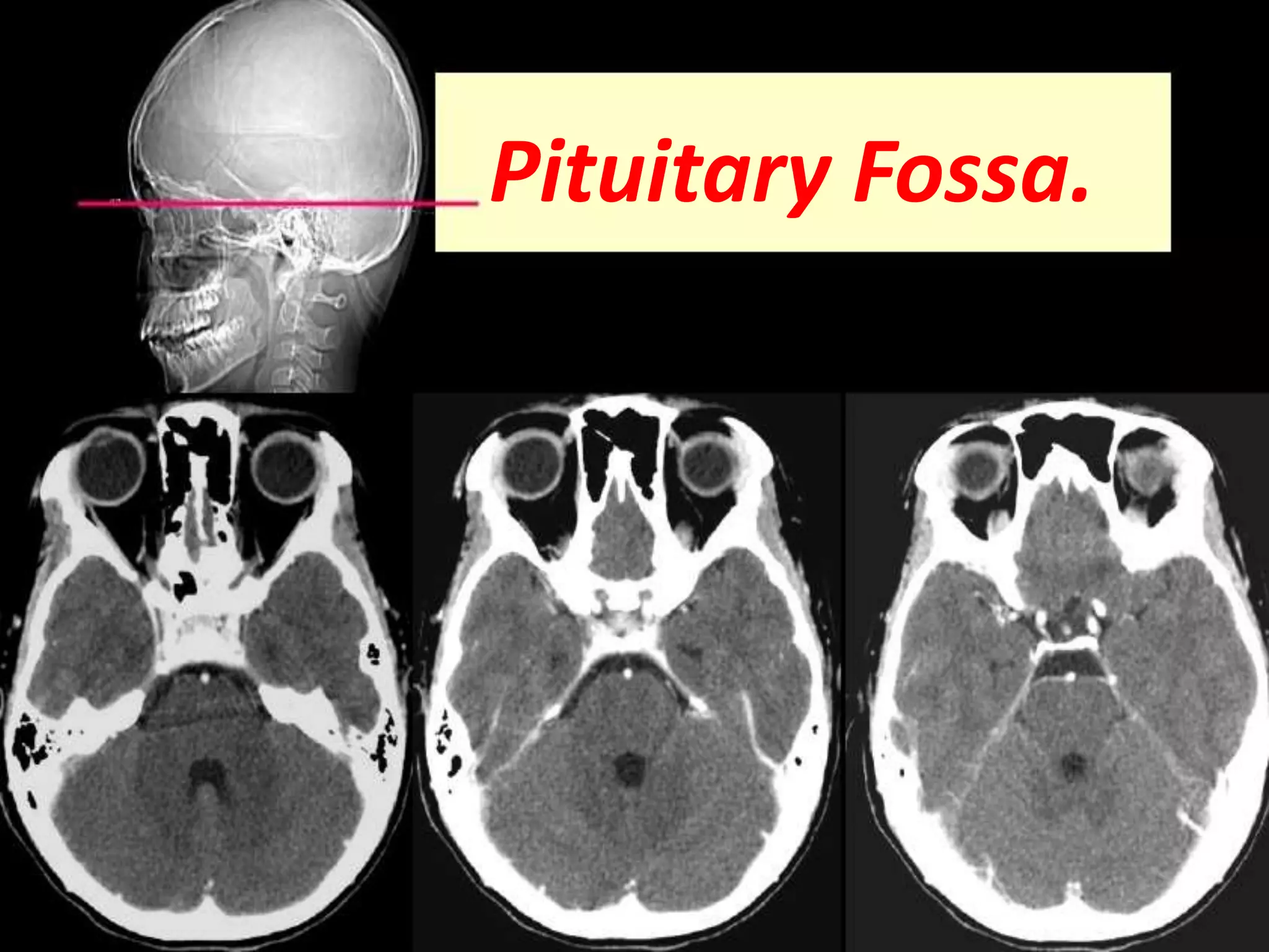 Pituitary Fossa. 
 