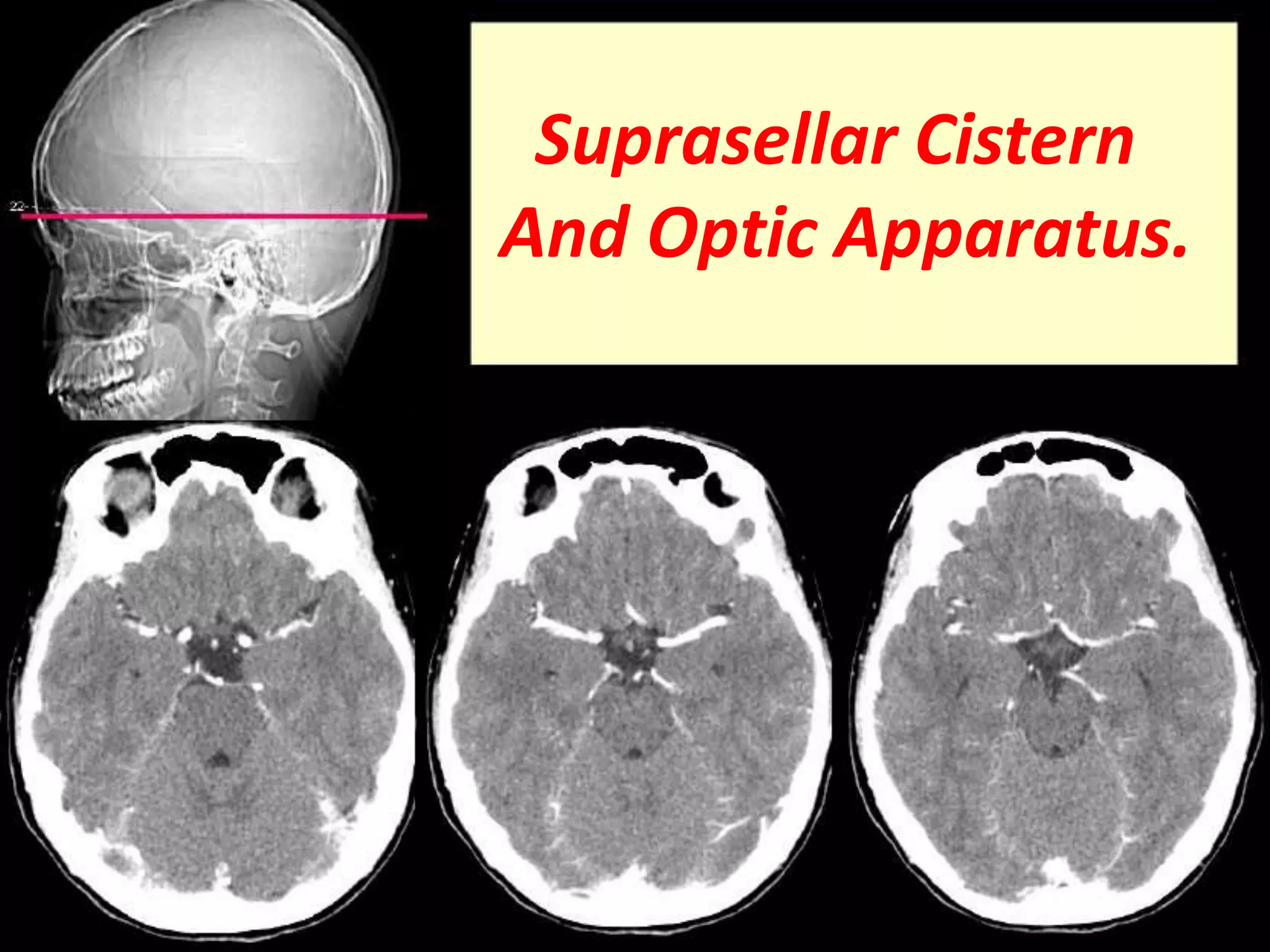 Suprasellar Cistern 
And Optic Apparatus. 
 