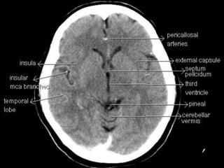 Cardunculus Brain Presentation1.pptx, radiological anatomy of the brain and pituitary ...