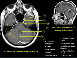 Cardunculus Brain Presentation1.pptx, radiological anatomy of the brain and pituitary ...