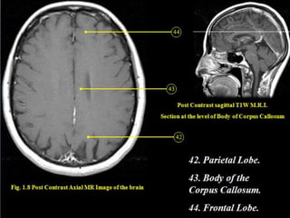 Cardunculus Brain Presentation1.pptx, radiological anatomy of the brain and pituitary ...