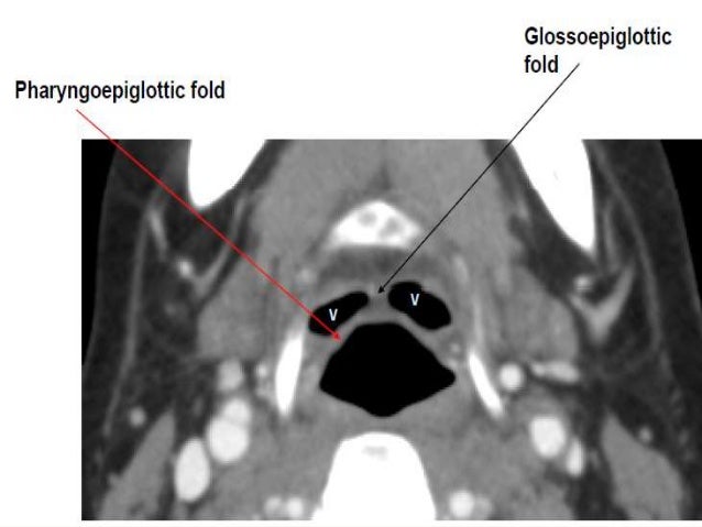 Presentation1 Pptx Radiological Anatomy Of The Neck