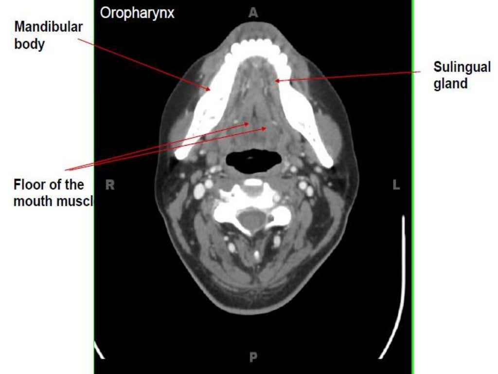 Presentation1.pptx, radiological anatomy of the neck.
