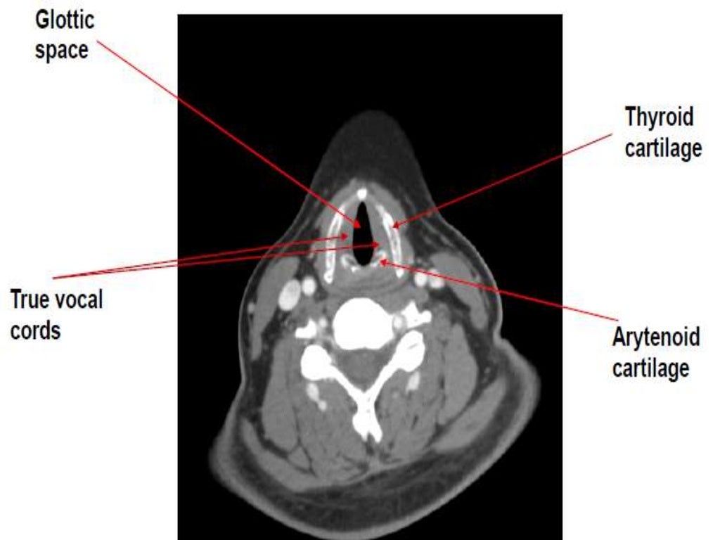 Presentation1.pptx, radiological anatomy of the neck.