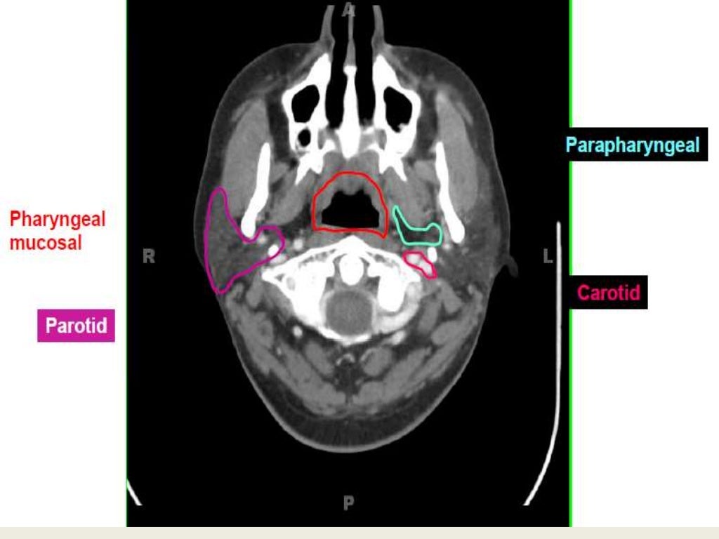 Presentation1.pptx, radiological anatomy of the neck.