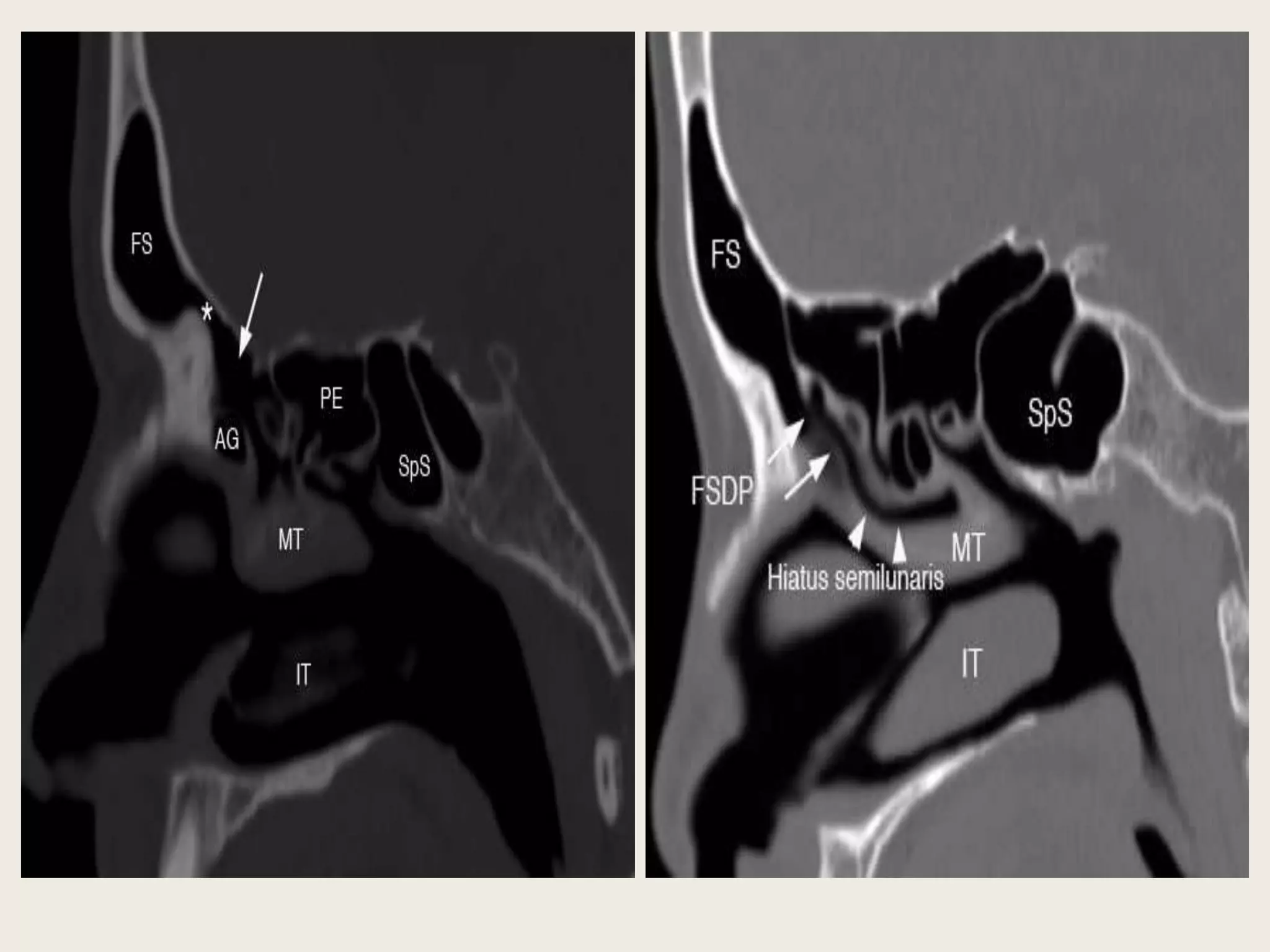 Presentation1 pptx radiological anatomy of the orbits pns and petrous