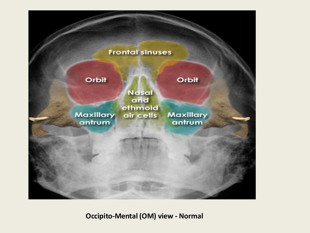 Presentation1 pptx radiological anatomy of the orbits pns and petro 