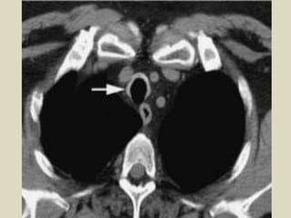 MR imaging, larynx. Image 3 of 3. T1-weighted axial slice above Image 1 showing the 
epiglottis (arrow) and the vallecula,...