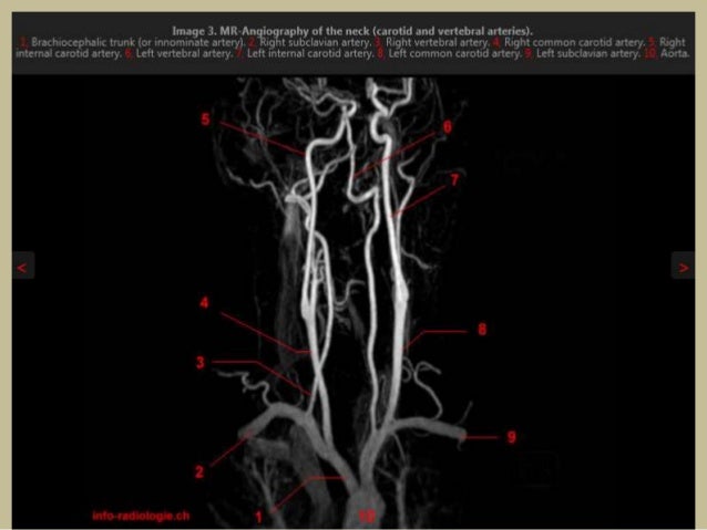 Изгиб вса. Сегменты внутренней сонной артерии. Ангиография позвоночной артерии. Внутренняя Сонная артерия анатомия ветви. Внутренняя Сонная артерия анатомия кт.