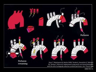 Kazui T, Washiyama N, Bashar AHM, Terada H, Yamashita K, Takinami 
M, Tamiya Y. Total arch replacement using aortic arch branched grafts 
with the aid of antegrade selective cerebral perfusion. Ann Thorac Surg 
2000;70:3–9. 
 