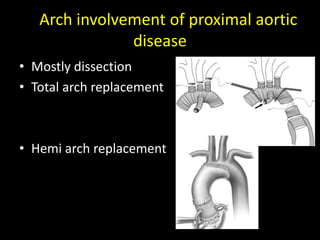 ArArch involvement of proximal aortic 
disease 
• Mostly dissection 
• Total arch replacement 
• Hemi arch replacement 
 