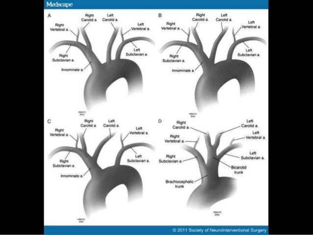 complex aortic arch surgery