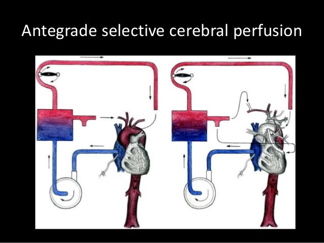 complex aortic arch surgery