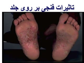 تاثیرات فنجی بر روی جلد 
 