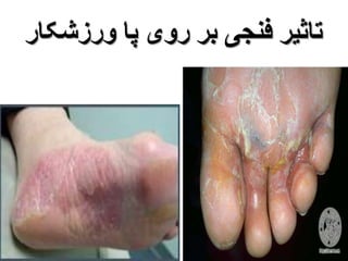 تاثیر فنجی بر روی پا ورزشکار 
 