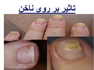 تاثیر بر روی ناخن 
 
