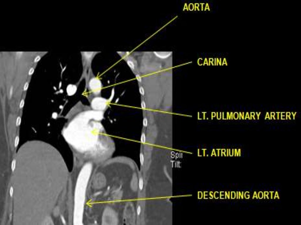 Venous Anatomy Of Chest / Vascular Anatomy of the Upper Thorax Medical