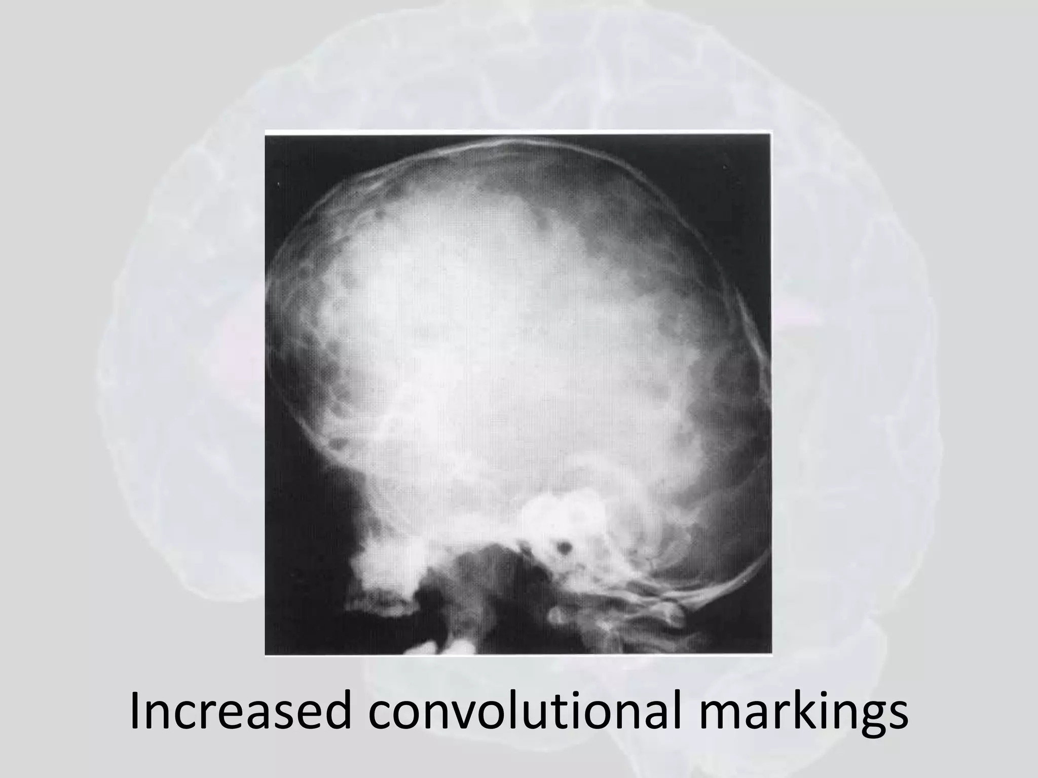 Increased convolutional markings 
 