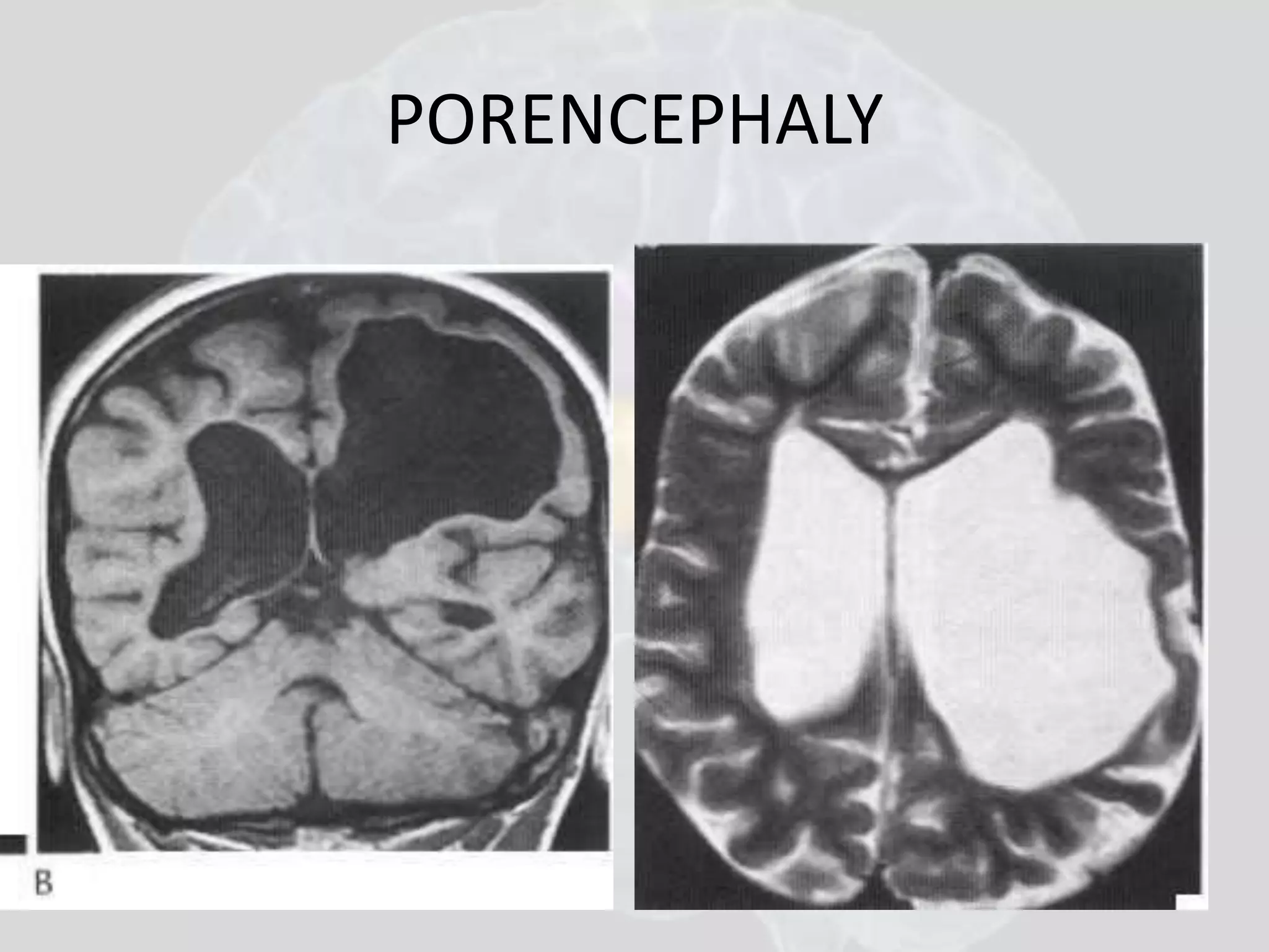 PORENCEPHALY 
 