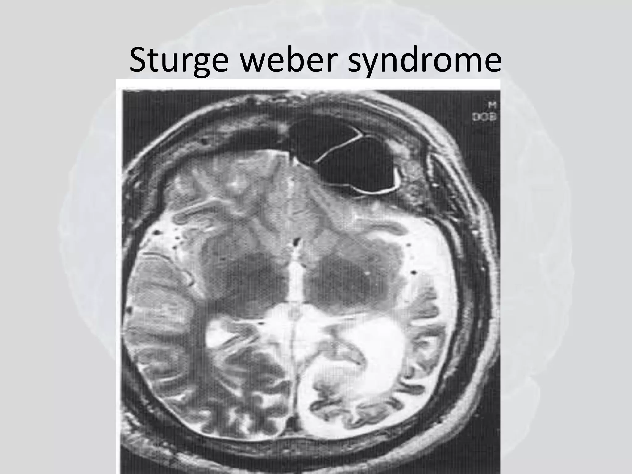 Sturge weber syndrome 
 
