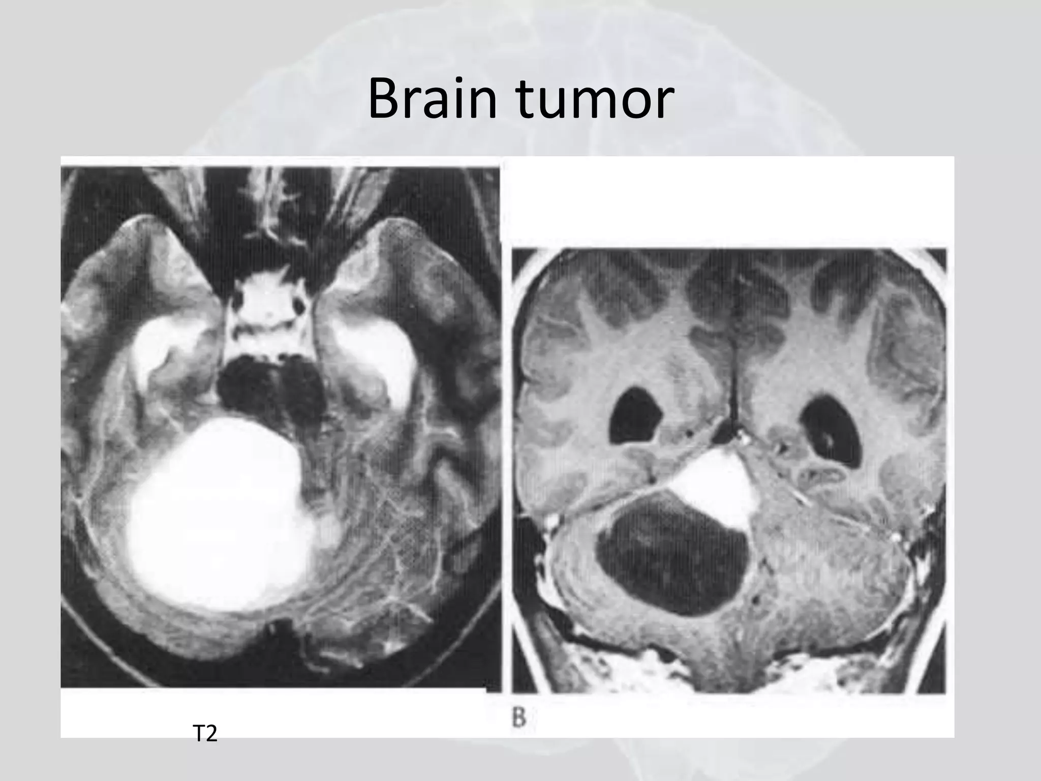Brain tumor 
T2 
 