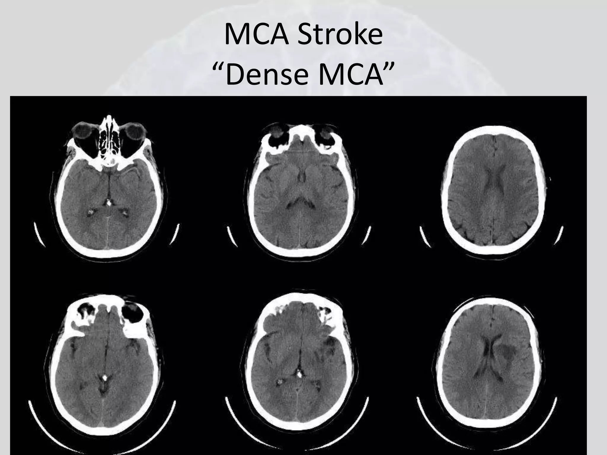 MCA Stroke 
“Dense MCA” 
 