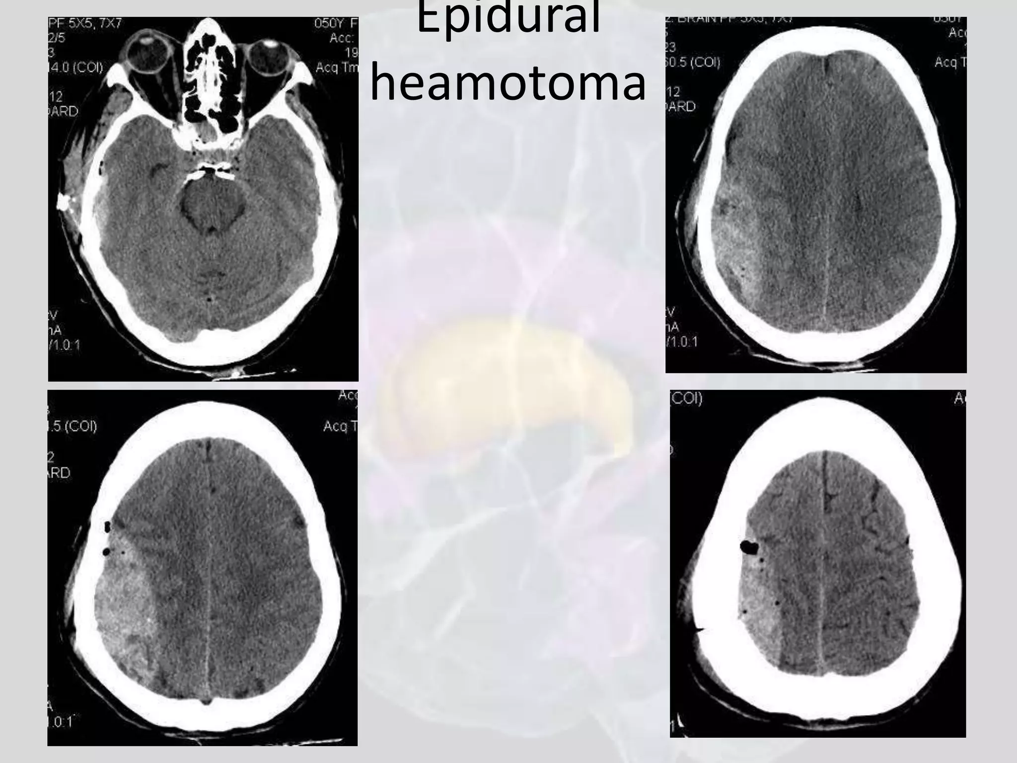 Epidural 
heamotoma 
 