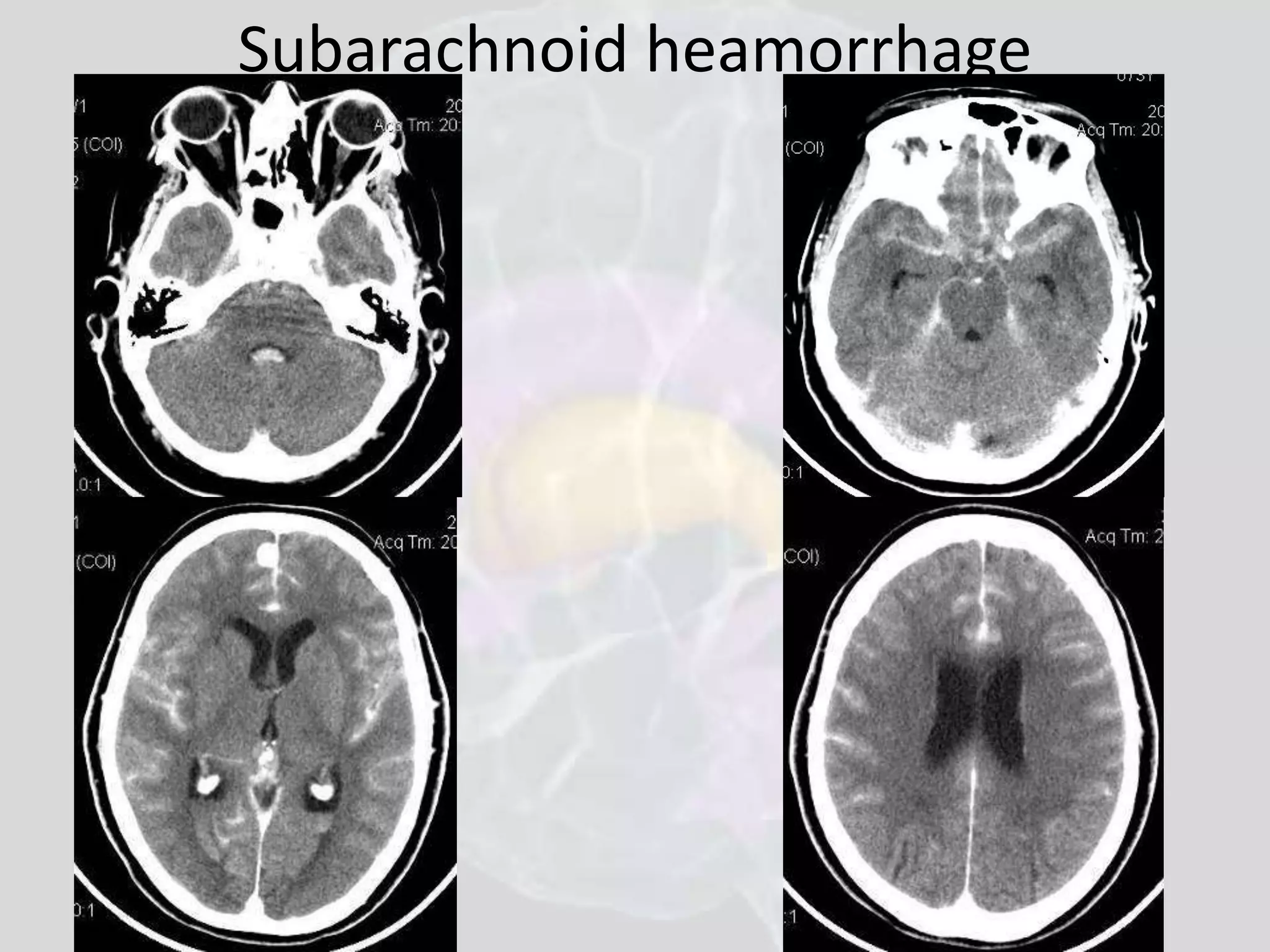 Subarachnoid heamorrhage 
 