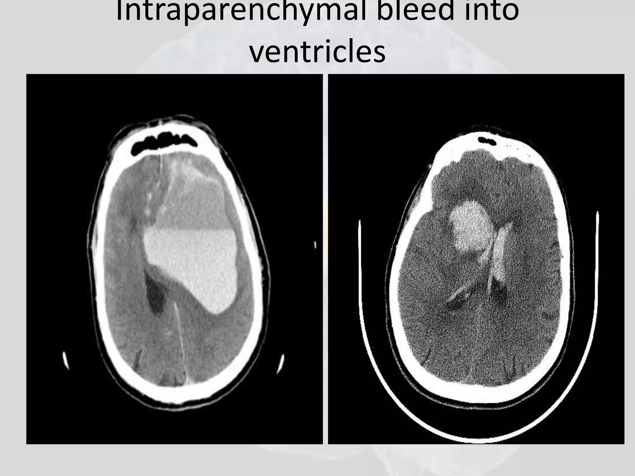Intraparenchymal bleed into 
ventricles 
 