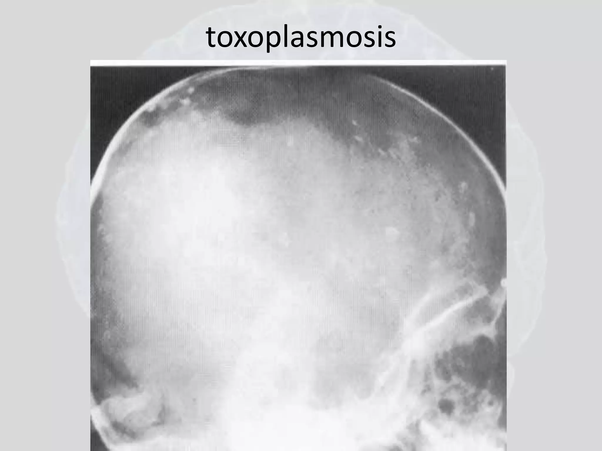toxoplasmosis 
 