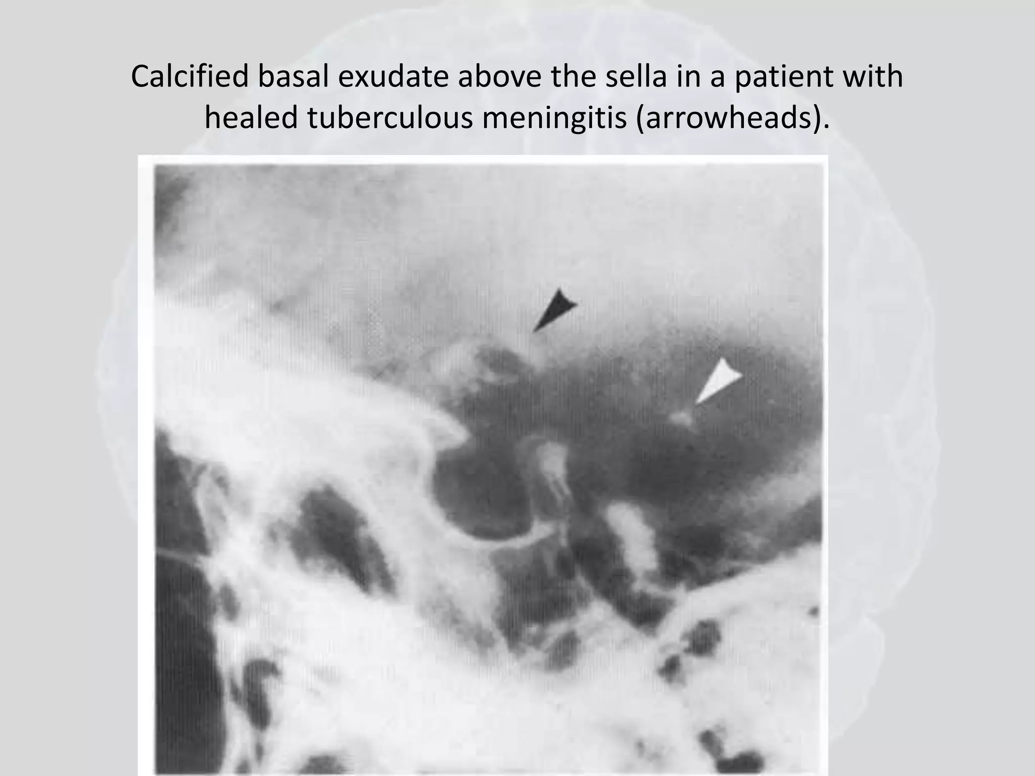 Calcified basal exudate above the sella in a patient with 
healed tuberculous meningitis (arrowheads). 
 