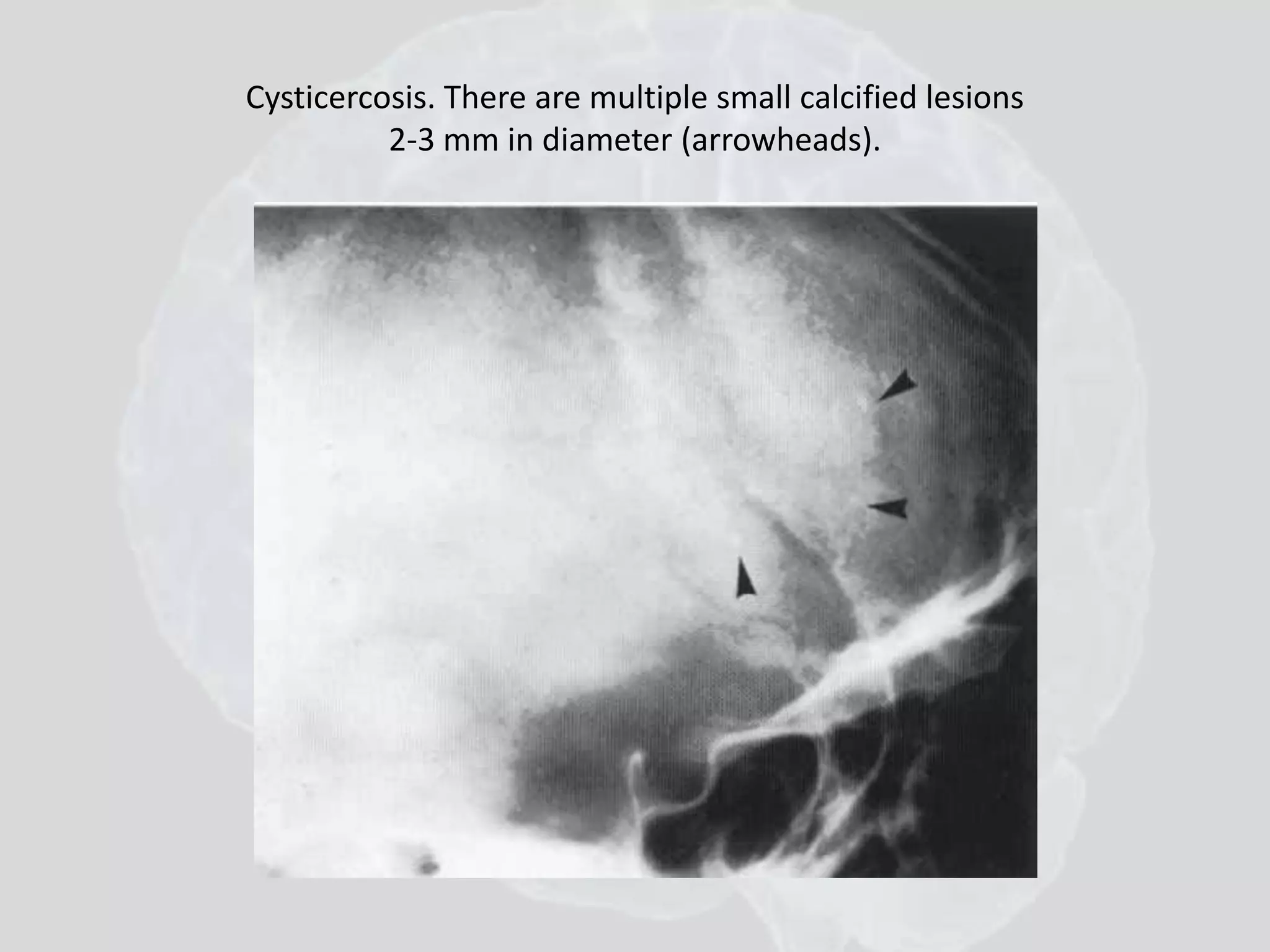 Cysticercosis. There are multiple small calcified lesions 
2-3 mm in diameter (arrowheads). 
 