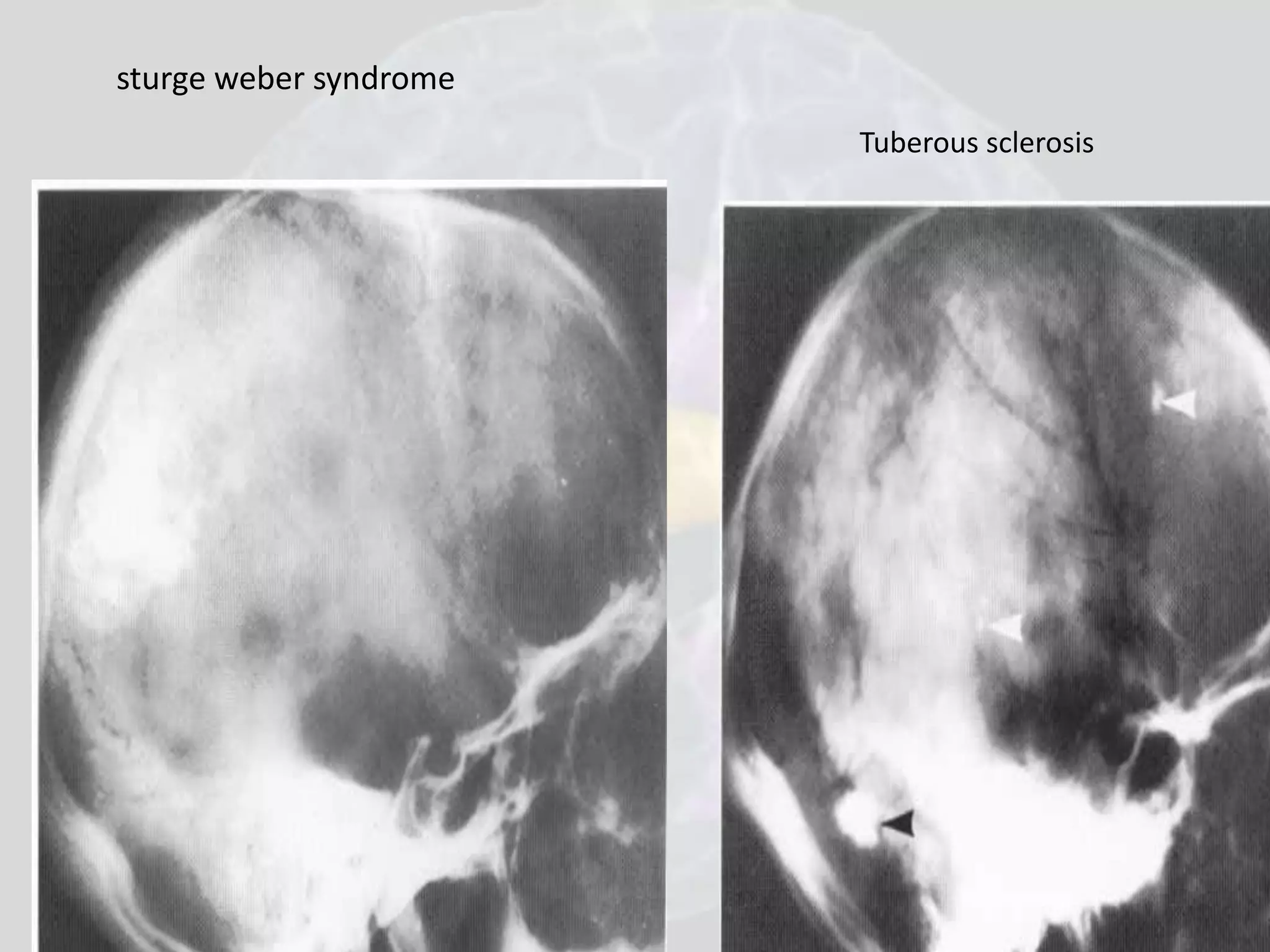 sturge weber syndrome 
Tuberous sclerosis 
 